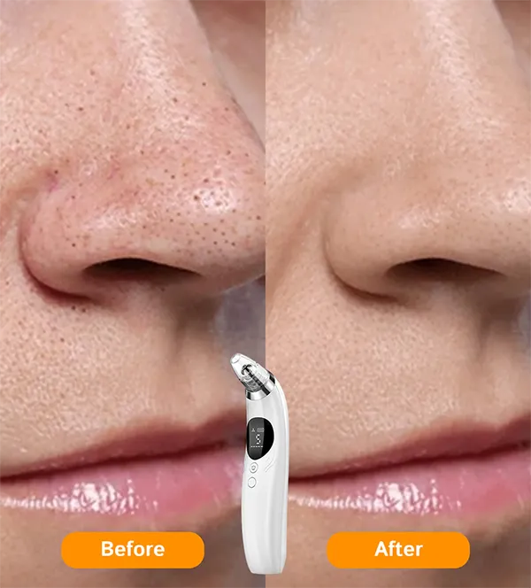 BlaRevia Blackhead Remover Vacuum – 5-Probe Electric Pore Cleaner for Women & Men