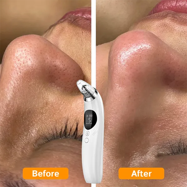 BlaRevia Blackhead Remover Vacuum – 5-Probe Electric Pore Cleaner for Women & Men