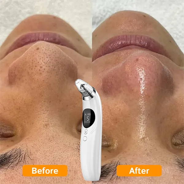 BlaRevia Blackhead Remover Vacuum – 5-Probe Electric Pore Cleaner for Women & Men