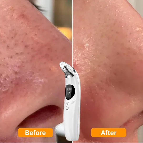 BlaRevia Blackhead Remover Vacuum – 5-Probe Electric Pore Cleaner for Women & Men