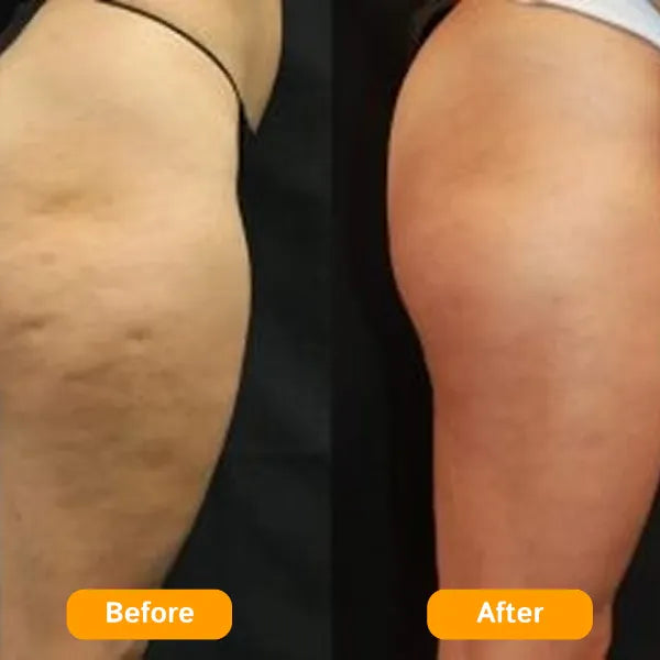 Z3 ZemoKL Cellulite Remover US8390