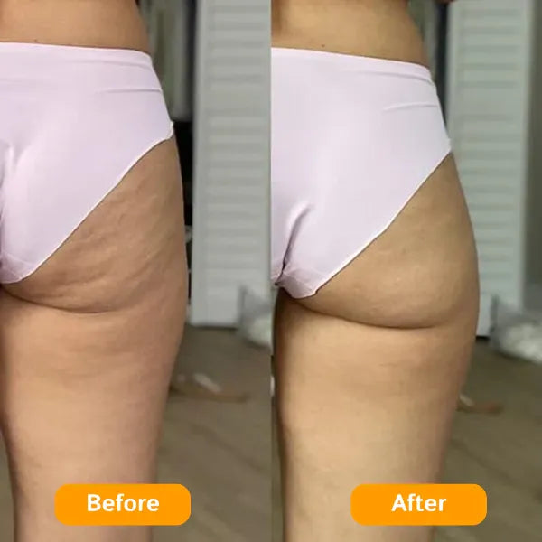 Z3 ZemoKL Cellulite Remover US8390