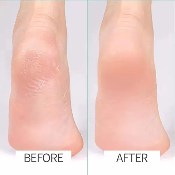 N2 ReCalus Foot Callus Remover
