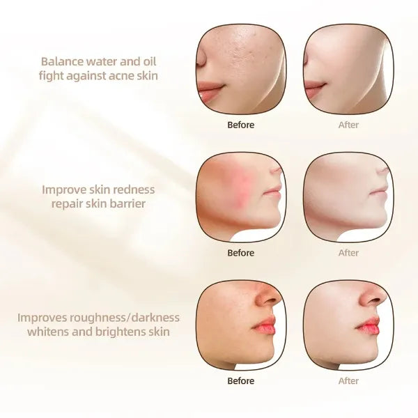 HMiAcne Red Light Therapy Mask – Wireless LED Silicone Face Mask with Eye Protection for Acne & Skin Rejuvenation